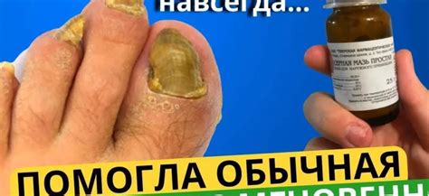 Альтернативные методы лечения грибка без дарсонваля