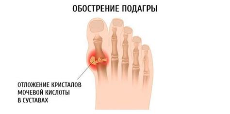 Альтернативы аденурику при обострении подагры
