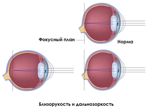 Виды ослабления и потери зрения
