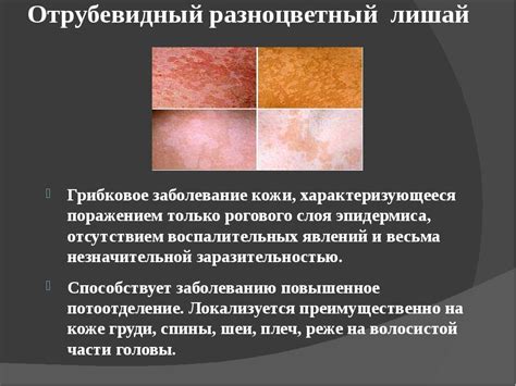 Влияние загара на лишай