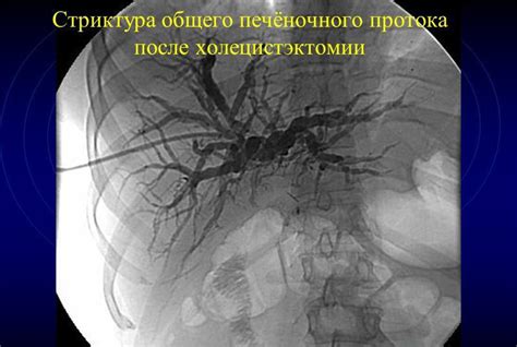 Влияние противозачаточных на здоровье желчного пузыря после хирургического вмешательства