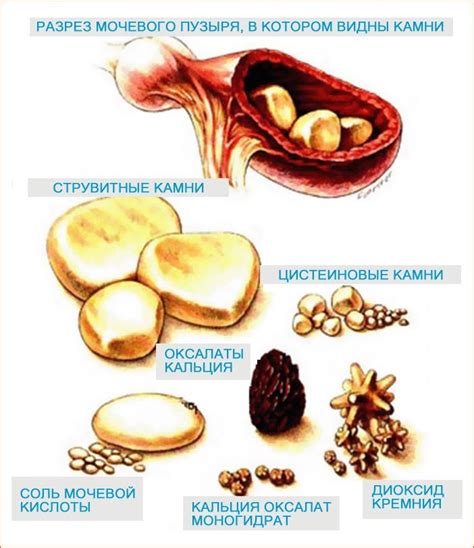 Какие камни в почках можно пить каркаде