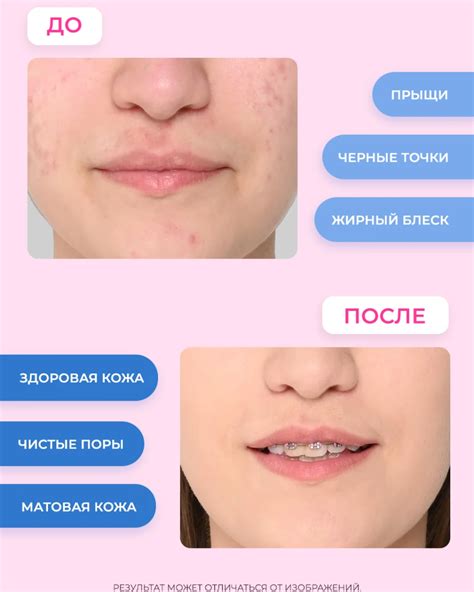 Мнения экспертов о возможных причинах появления прыщей