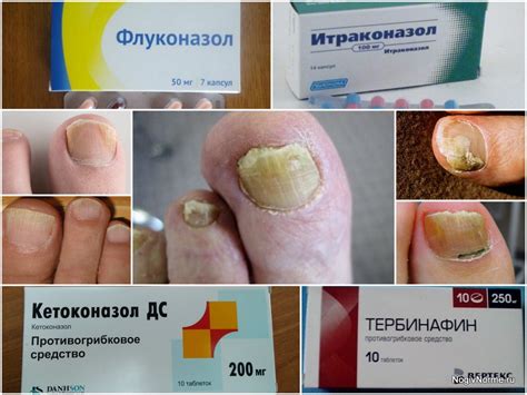 Опасность самостоятельного лечения грибка дарсонвалем