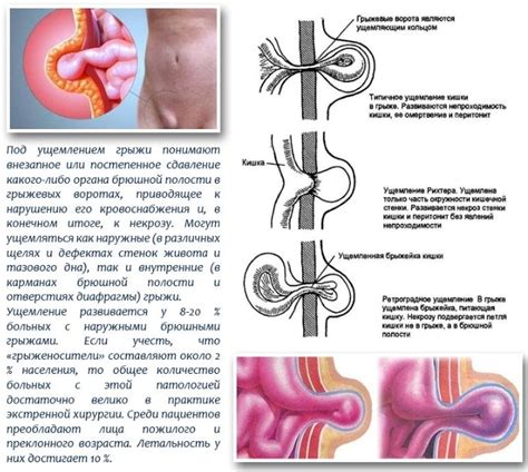 Паховая грыжа: симптомы и причины
