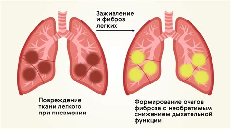 Причины ослабленности организма при воспалении легких