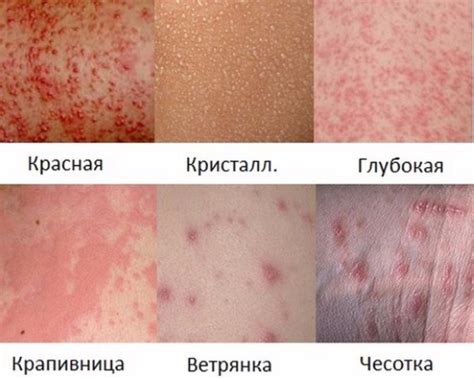 Различные виды нервных высыпаний на лице