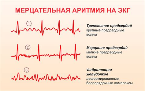 Рекомендации по употреблению чеснока при мерцательной аритмии