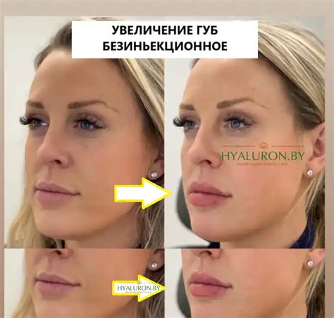 Связь между увеличением губ и визуализацией носа