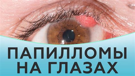 Суть проблемы: папилломы под глазом
