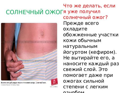 Что делать, если все же получил ожог