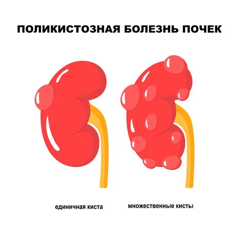 Что такое поликистоз