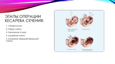 Эффект чая после кесарева сечения